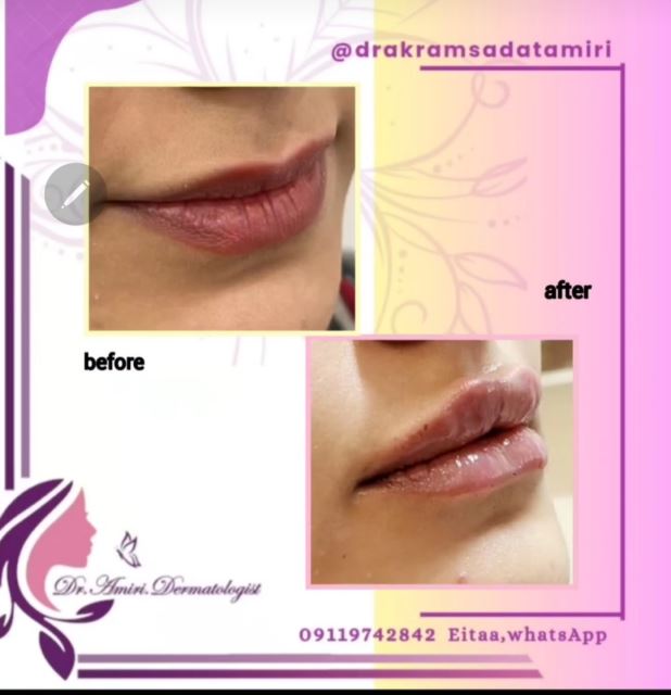 فیلر لب