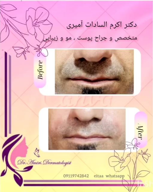 فیلر خط خنده