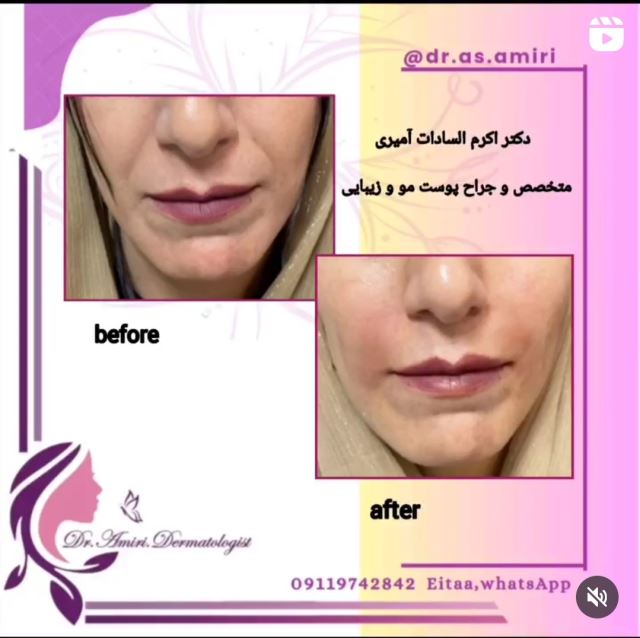 فیلر خط خنده