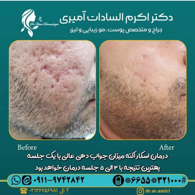 درمان اسکار اکنه با روش های ترکیبی