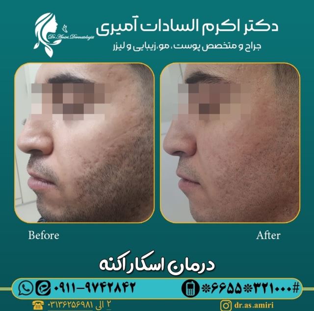 لیزر اسکار اکنه