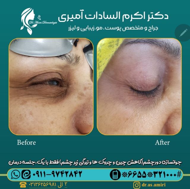 درمان تیرگی و چین و چروک دور چشم