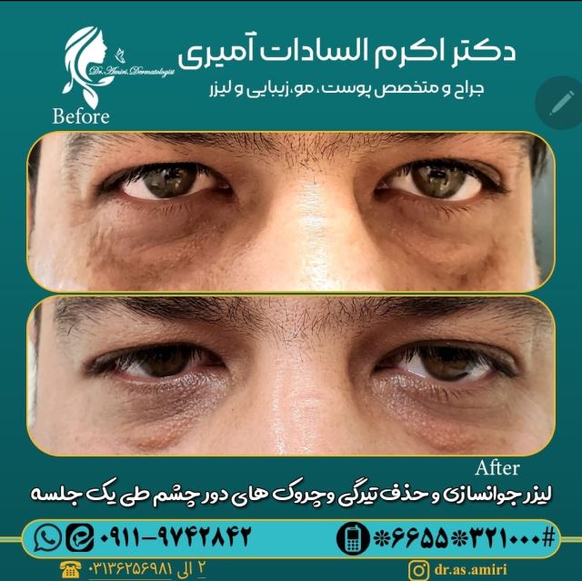 درمان تیرگی و چروک دور چشم