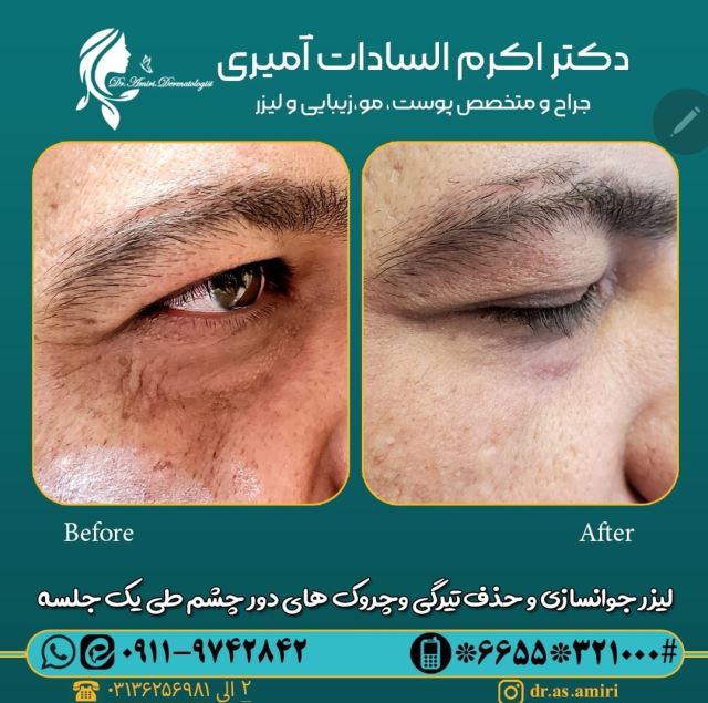 رفع چین و چروک دور چشم با یک جلسه لیزر