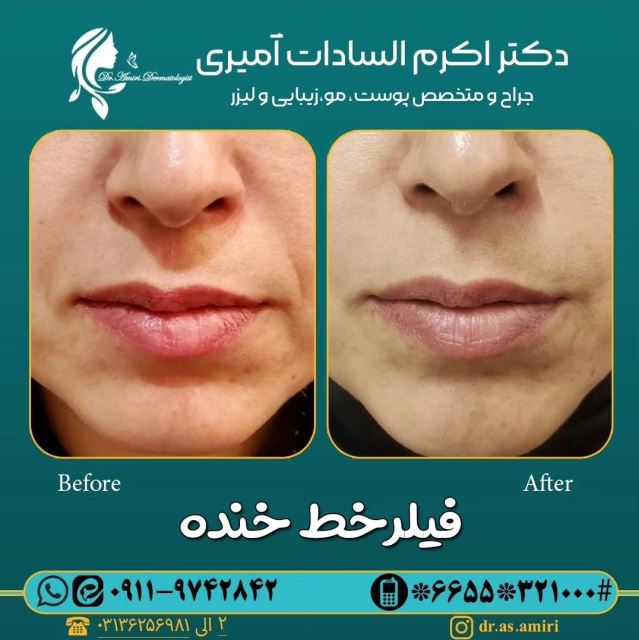 فیلر خط خنده