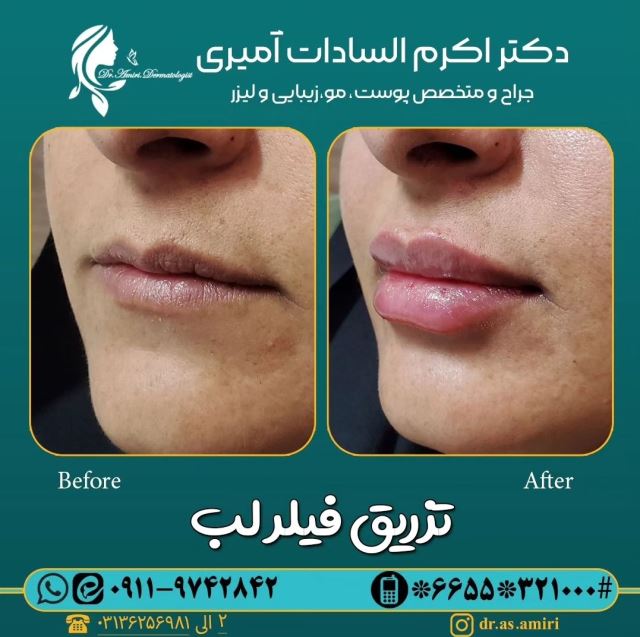 فیلر لب روسی