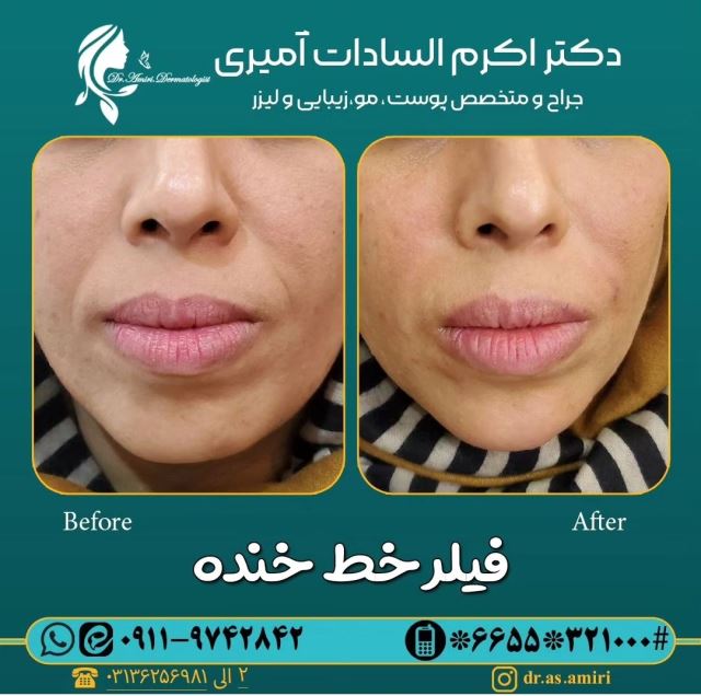 فیلر خط خنده