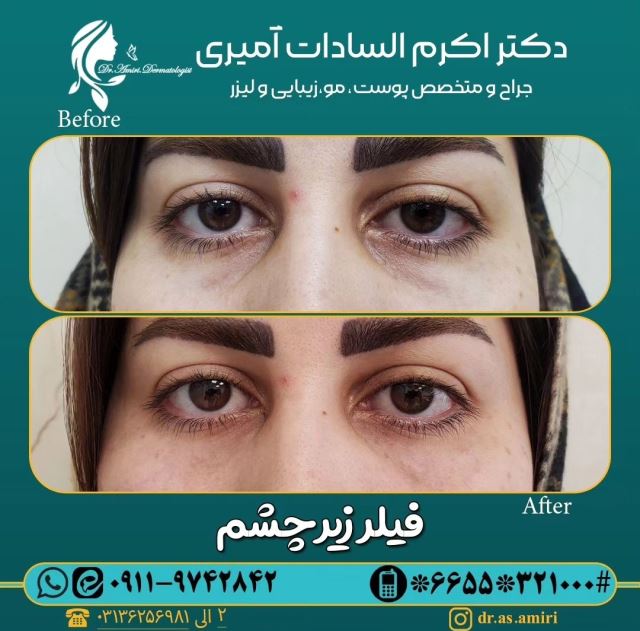 فیلر زیر چشم