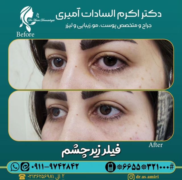 فیلر زیر چشم