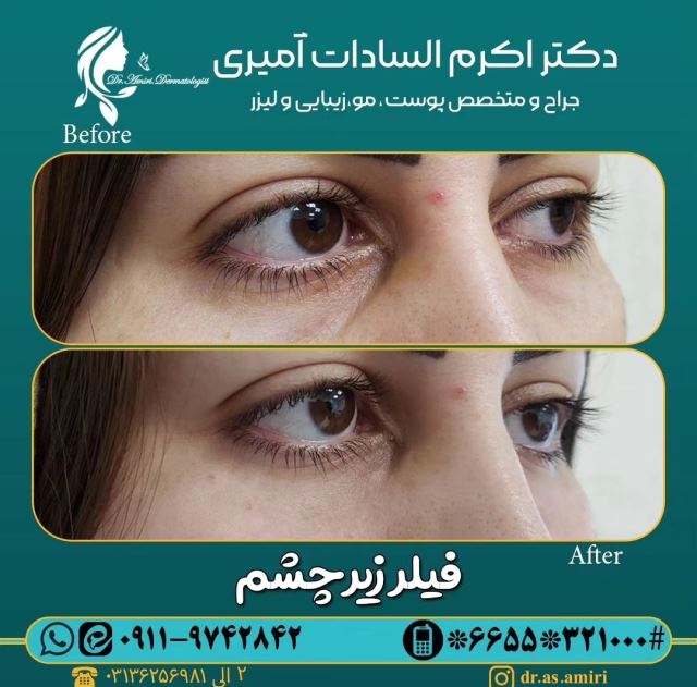 فیلر زیر چشم