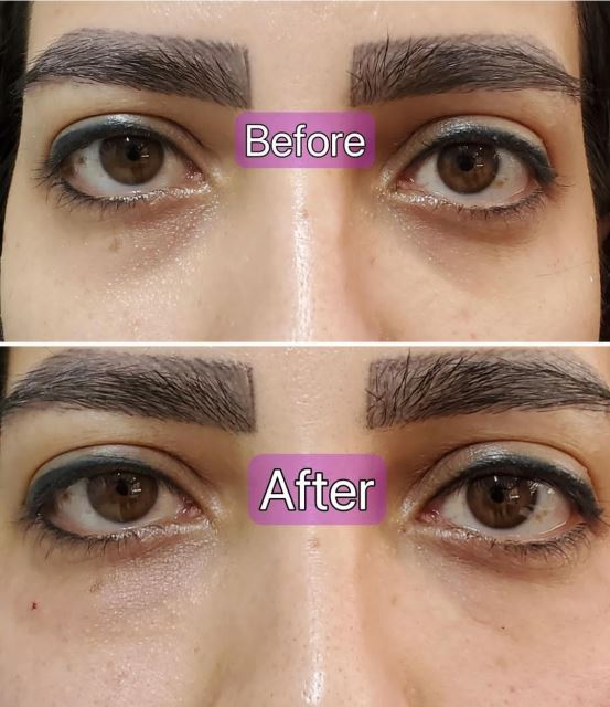 فیلر زیر چشم