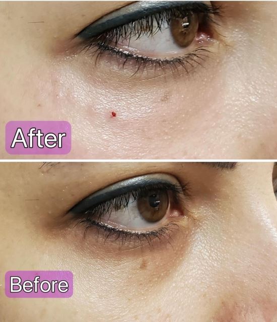 فیلر زیر چشم