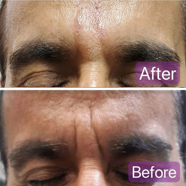 فیلر خط اخم