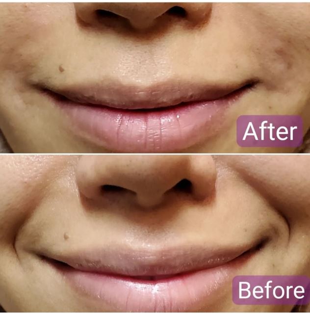 فیلر خط خنده