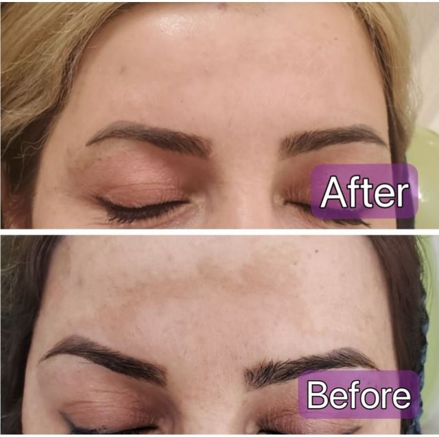 درمان ملاسما