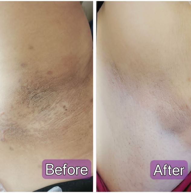 تیرگی زیر بغل