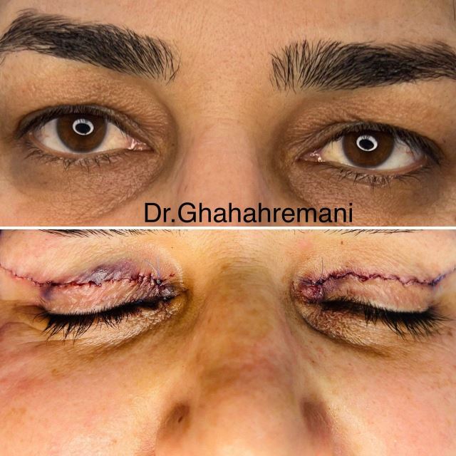 افتادگی پلک