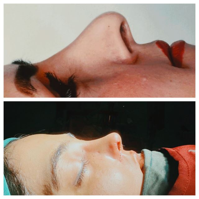 قبل و بعد از عمل