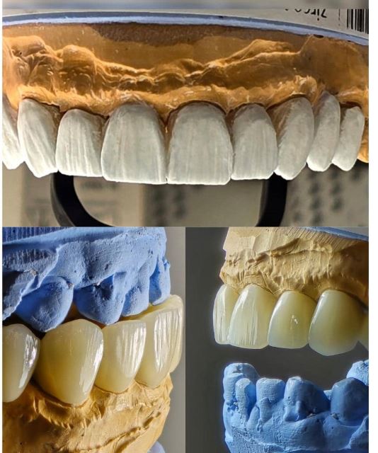 پرسلن گذاری