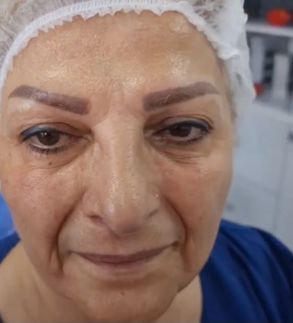 قبل از تزریق فیلر خط خنده