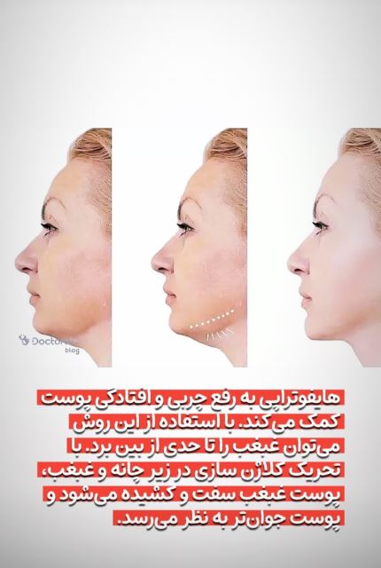 کاربرد هایفوتراپی