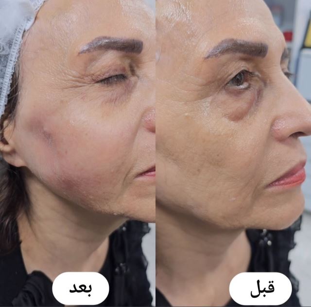 هایفوتراپی