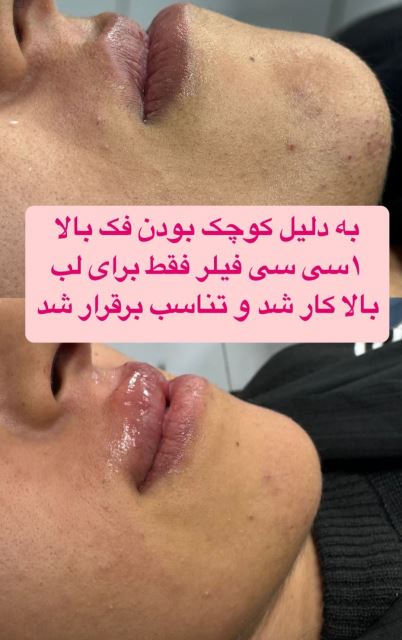 فیلر لب بالا