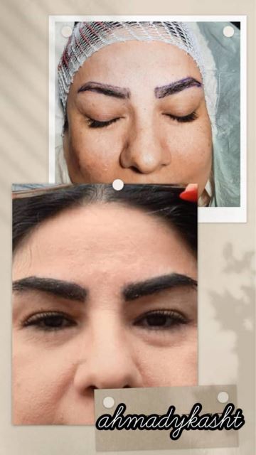 کاشت مو و ابرو ارزان در غرب تهران