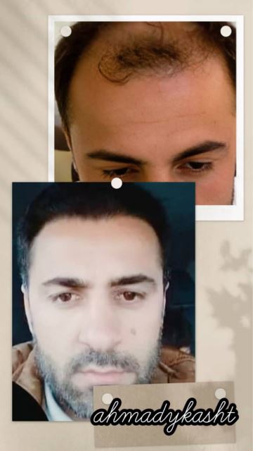 کاشت مو و ابرو ارزان در غرب تهران