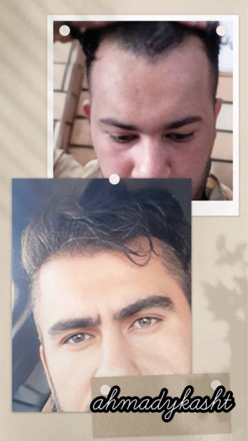 کاشت مو و ابرو تضمینی در غرب تهران