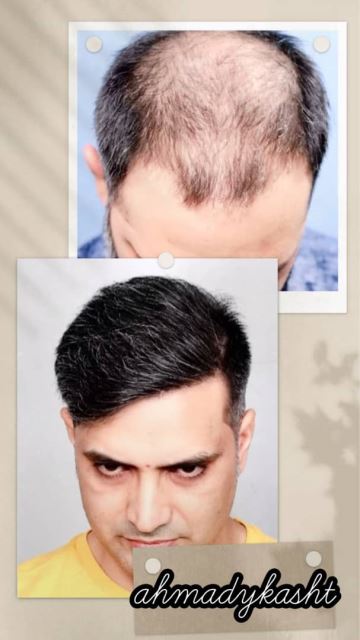 کاشت مو و ابرو تضمینی در غرب تهران