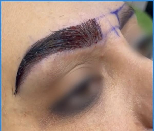 نکاتی در مورد کاشت ابرو به روش SUT