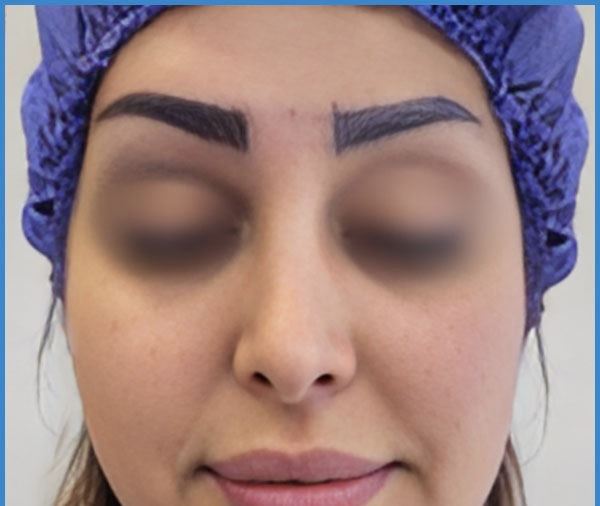 بهترین کلینیک کاشت ابرو به روش SUT