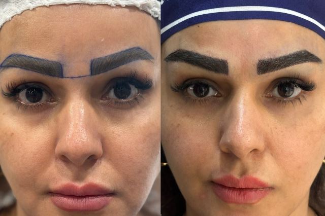 بهترین دکتر کاشت ابرو در اردبیل