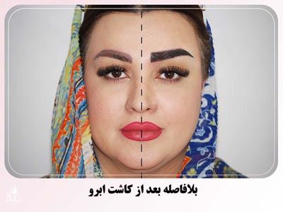 بهترین متخصص کاشت ابرو در پارس آباد