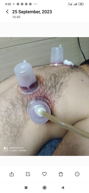 حجامت عام وکبد