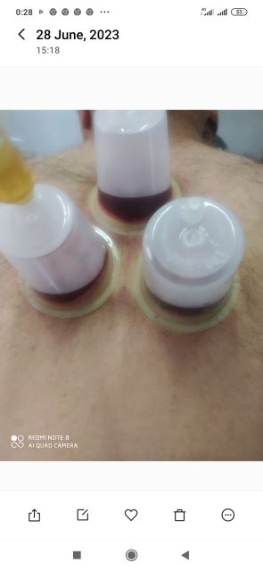 حجامت قاعده ریه به همراه حجامت عام