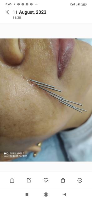 طب سوزنی زیبایی