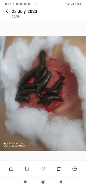 زالوگذاری پشت قلب