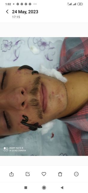 برای رفع آکنه