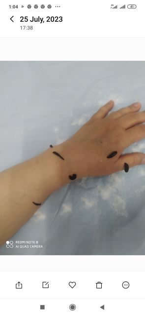 زالوگذاری روی دست